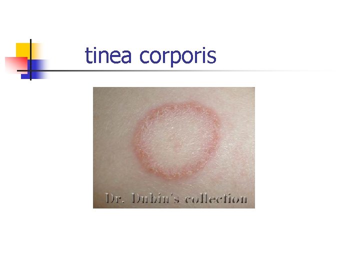 tinea corporis 