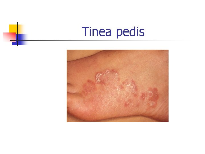 Tinea pedis 