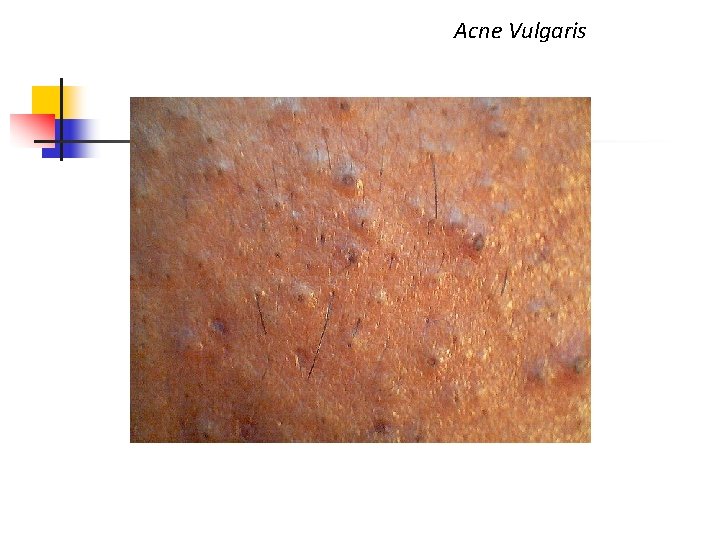 Acne Vulgaris 