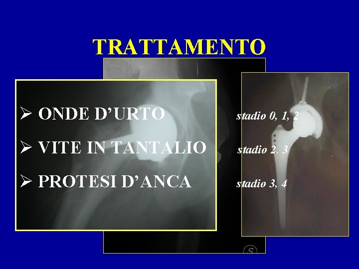 TRATTAMENTO Ø ONDE D’URTO stadio 0, 1, 2 Ø VITE IN TANTALIO stadio 2,