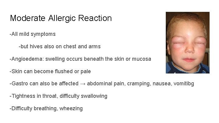 Moderate Allergic Reaction -All mild symptoms -but hives also on chest and arms -Angioedema: