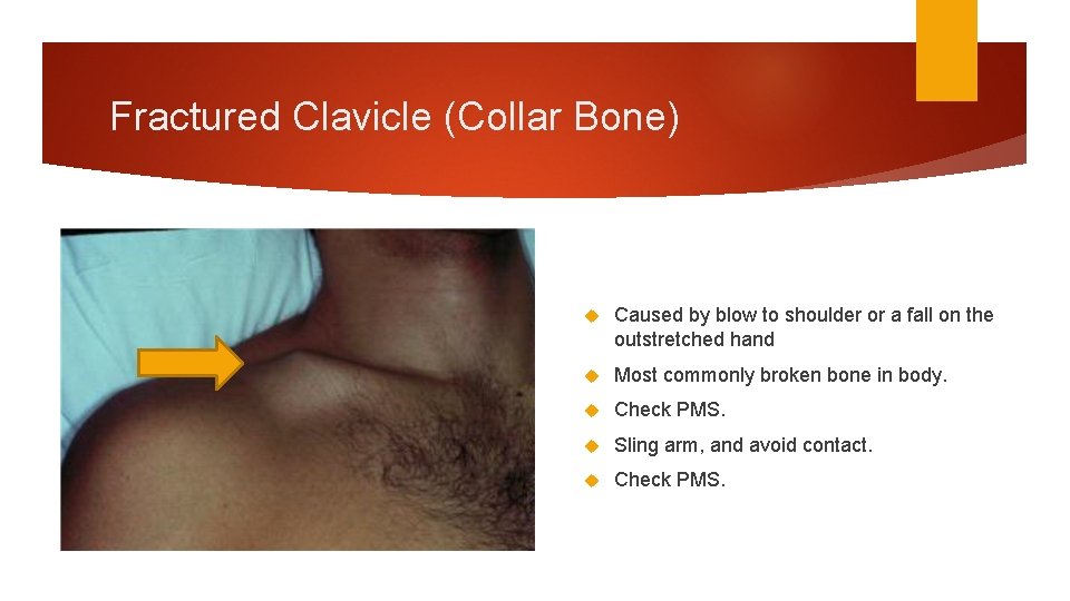 Fractured Clavicle (Collar Bone) Caused by blow to shoulder or a fall on the