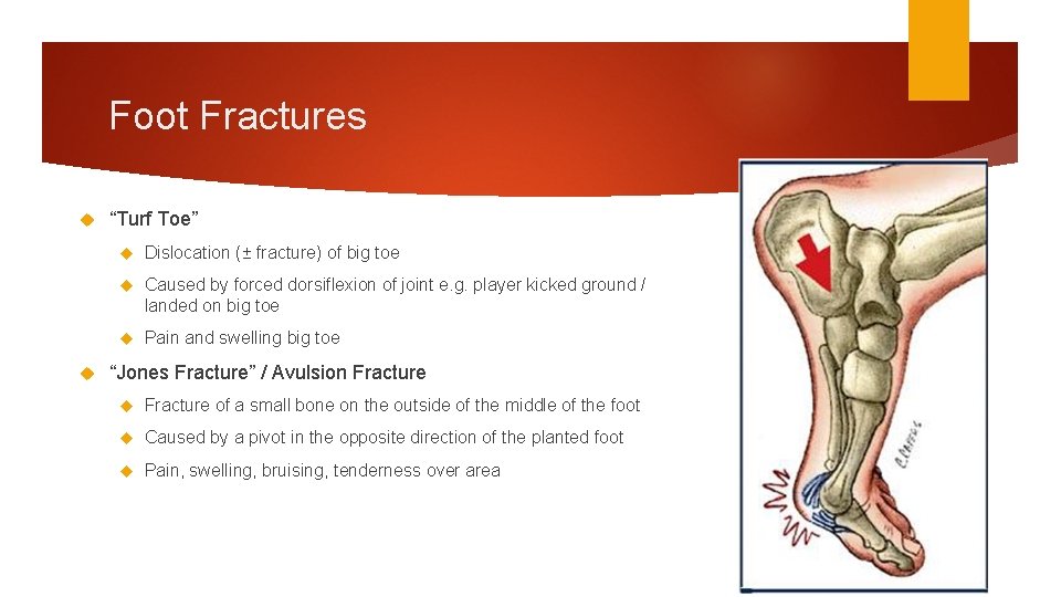 Foot Fractures “Turf Toe” Dislocation (± fracture) of big toe Caused by forced dorsiflexion
