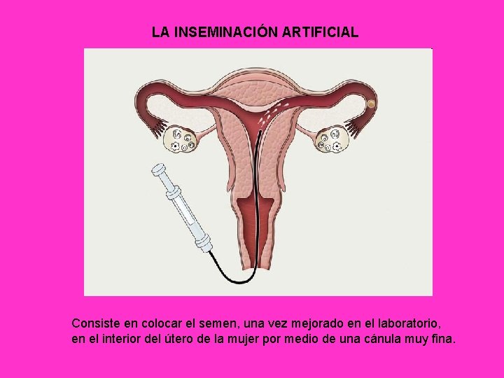 LA INSEMINACIÓN ARTIFICIAL Consiste en colocar el semen, una vez mejorado en el laboratorio,