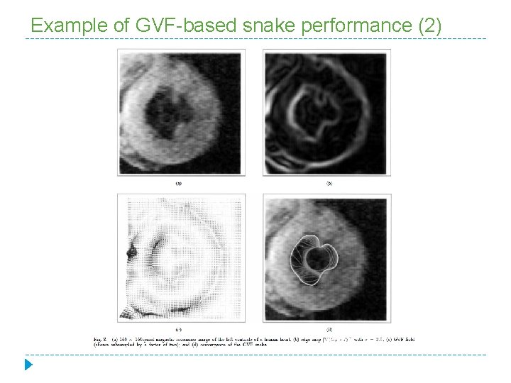 Example of GVF-based snake performance (2) 