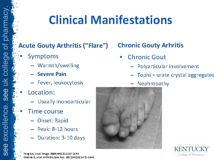 Clinical Manifestations Acute Gouty Arthritis (“Flare”) • Symptoms – Warmth/swelling – Severe Pain –