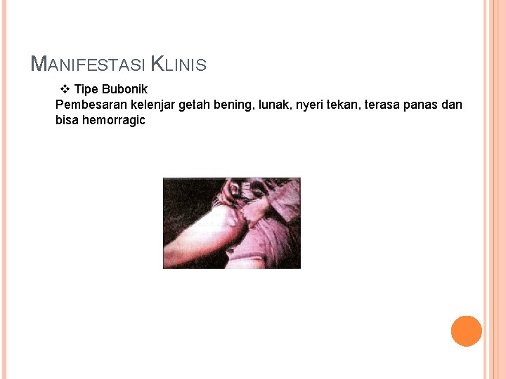 MANIFESTASI KLINIS v Tipe Bubonik Pembesaran kelenjar getah bening, lunak, nyeri tekan, terasa panas