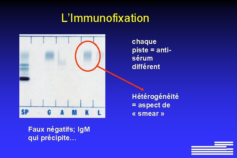 L’Immunofixation chaque piste = antisérum différent Hétérogénéité = aspect de « smear » Faux
