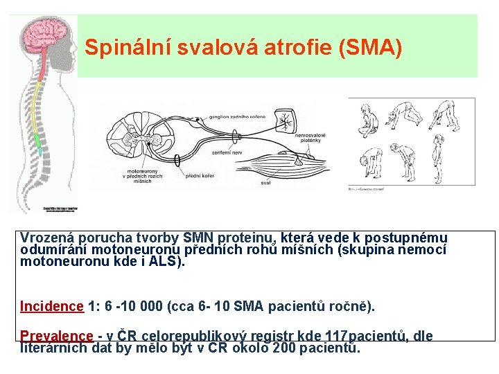 Spinální svalová atrofie (SMA) Vrozená porucha tvorby SMN proteinu, která vede k postupnému odumírání