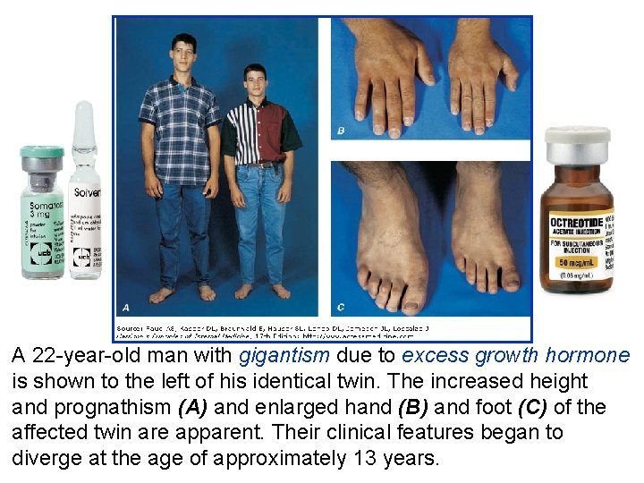 A 22 -year-old man with gigantism due to excess growth hormone is shown to