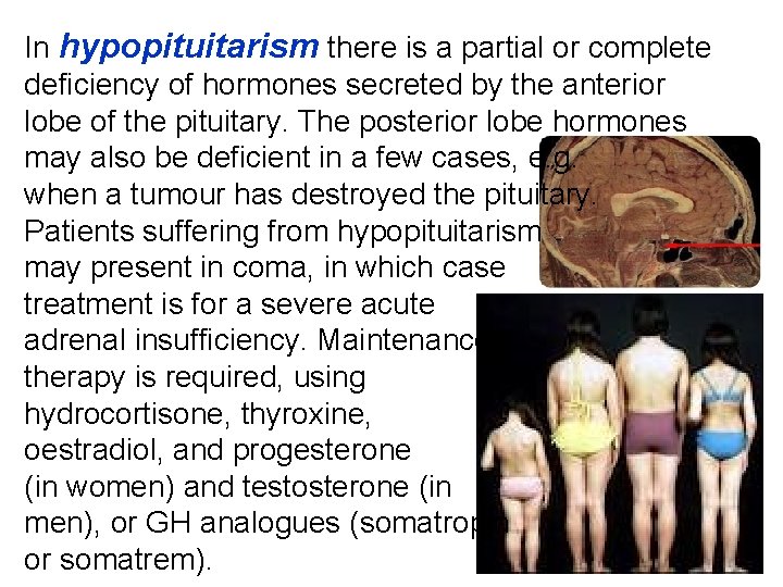 In hypopituitarism there is a partial or complete deficiency of hormones secreted by the