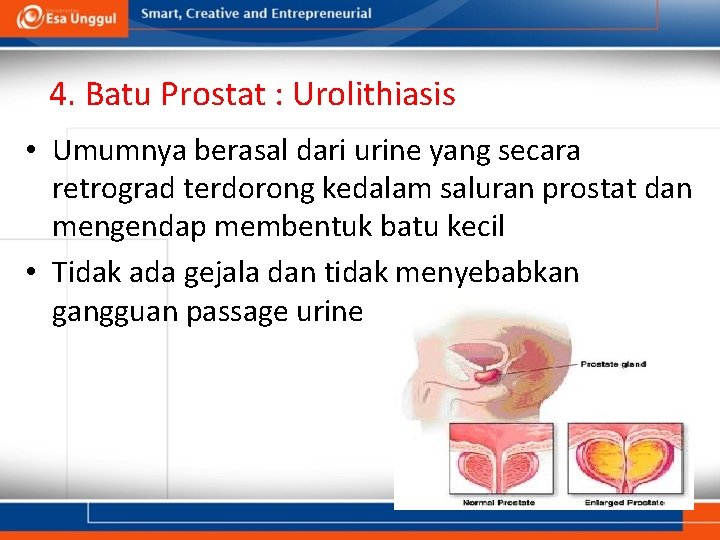 4. Batu Prostat : Urolithiasis • Umumnya berasal dari urine yang secara retrograd terdorong