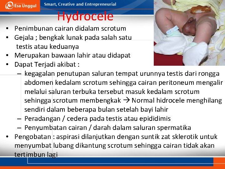 Hydrocele • Penimbunan cairan didalam scrotum • Gejala ; bengkak lunak pada salah satu