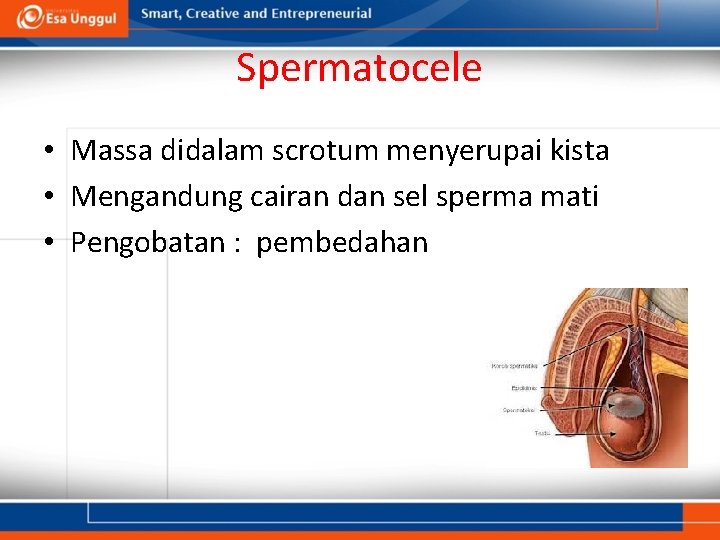 Spermatocele • Massa didalam scrotum menyerupai kista • Mengandung cairan dan sel sperma mati Spermatocele • Massa didalam scrotum menyerupai kista • Mengandung cairan dan sel sperma mati