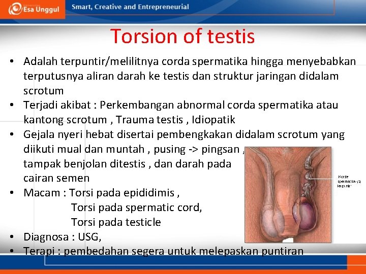 Torsion of testis • Adalah terpuntir/melilitnya corda spermatika hingga menyebabkan terputusnya aliran darah ke