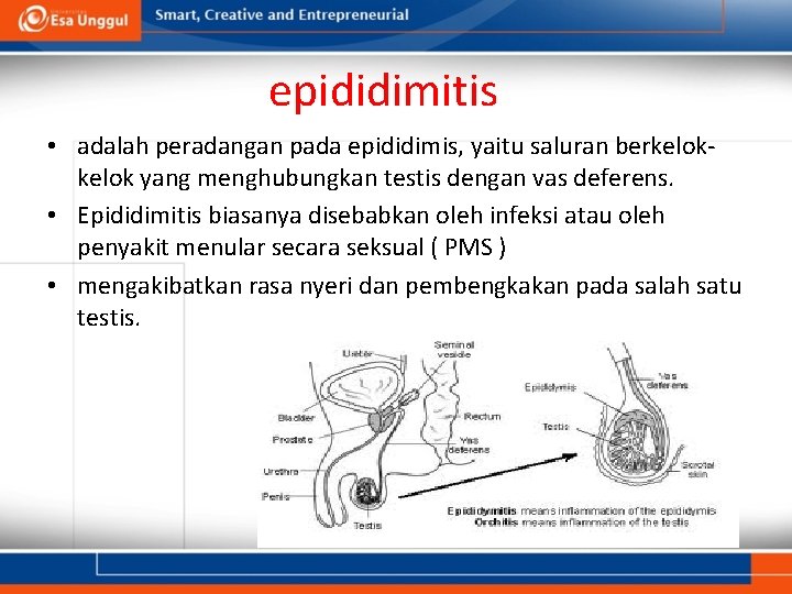 epididimitis • adalah peradangan pada epididimis, yaitu saluran berkelok yang menghubungkan testis dengan vas epididimitis • adalah peradangan pada epididimis, yaitu saluran berkelok yang menghubungkan testis dengan vas