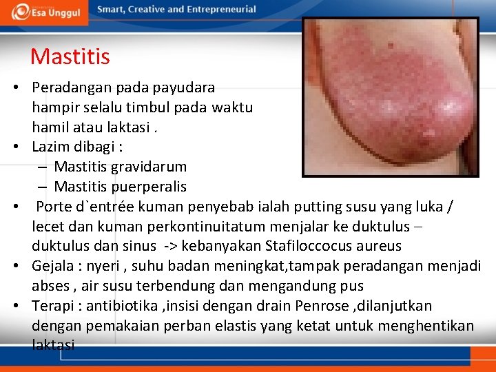 Mastitis • Peradangan pada payudara hampir selalu timbul pada waktu hamil atau laktasi. •