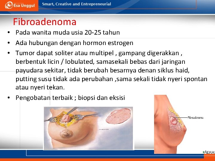 Fibroadenoma • Pada wanita muda usia 20 -25 tahun • Ada hubungan dengan hormon