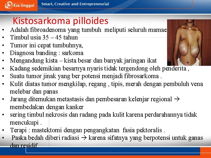 • • • Kistosarkoma pilloides Adalah fibroadenoma yang tumbuh meliputi seluruh mamae Timbul • • • Kistosarkoma pilloides Adalah fibroadenoma yang tumbuh meliputi seluruh mamae Timbul