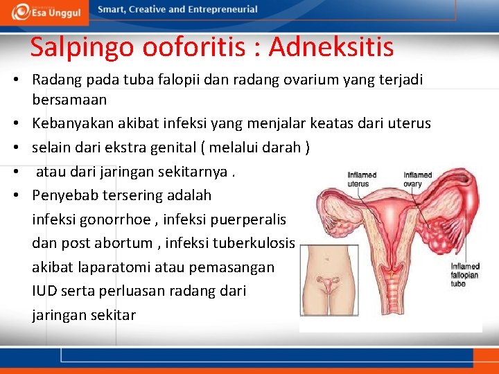 Salpingo ooforitis : Adneksitis • Radang pada tuba falopii dan radang ovarium yang terjadi