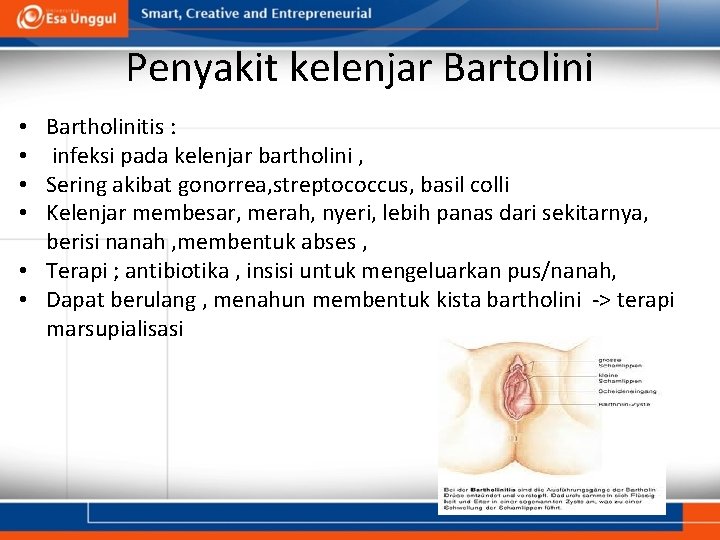 Penyakit kelenjar Bartolini Bartholinitis : infeksi pada kelenjar bartholini , Sering akibat gonorrea, streptococcus, Penyakit kelenjar Bartolini Bartholinitis : infeksi pada kelenjar bartholini , Sering akibat gonorrea, streptococcus,