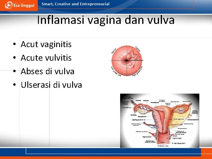 Inflamasi vagina dan vulva • • Acut vaginitis Acute vulvitis Abses di vulva Ulserasi