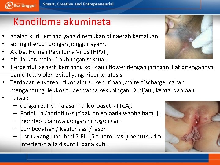 Kondiloma akuminata adalah kutil lembab yang ditemukan di daerah kemaluan. sering disebut dengan jengger