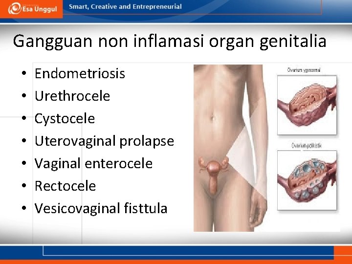 Gangguan non inflamasi organ genitalia • • Endometriosis Urethrocele Cystocele Uterovaginal prolapse Vaginal enterocele