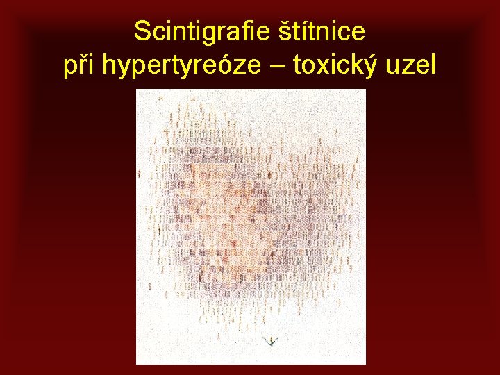 Scintigrafie štítnice při hypertyreóze – toxický uzel 