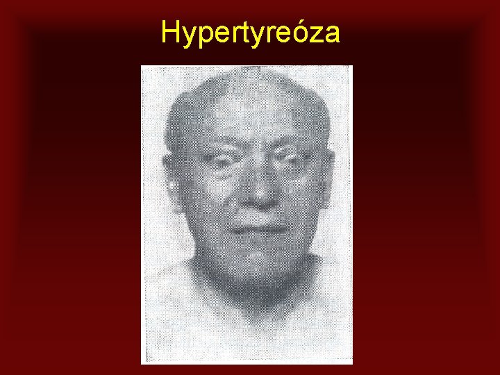 Hypertyreóza 