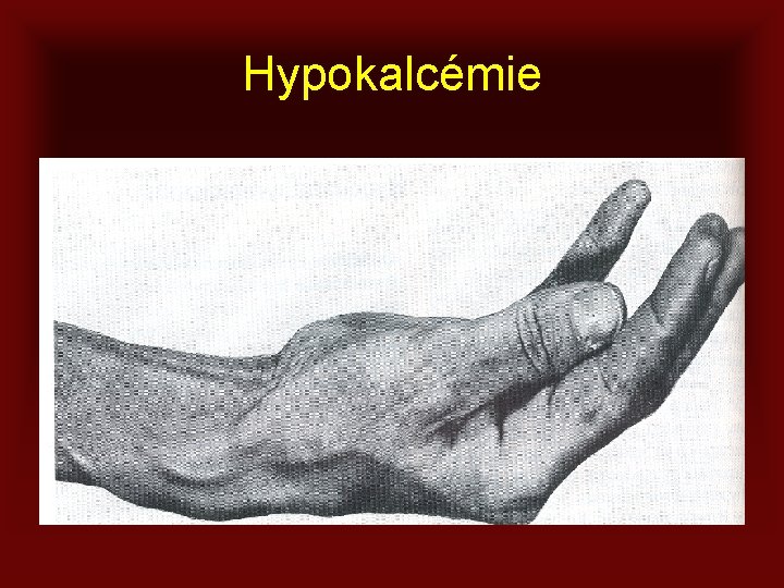 Hypokalcémie 