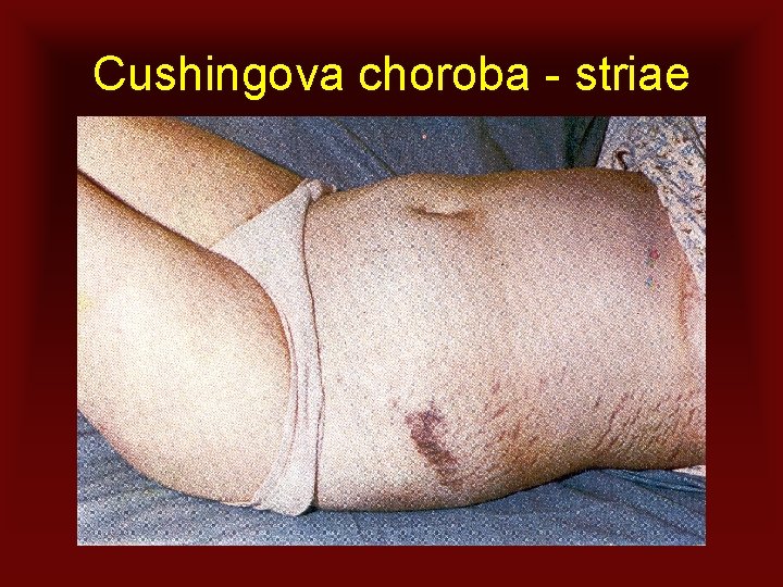 Cushingova choroba - striae 