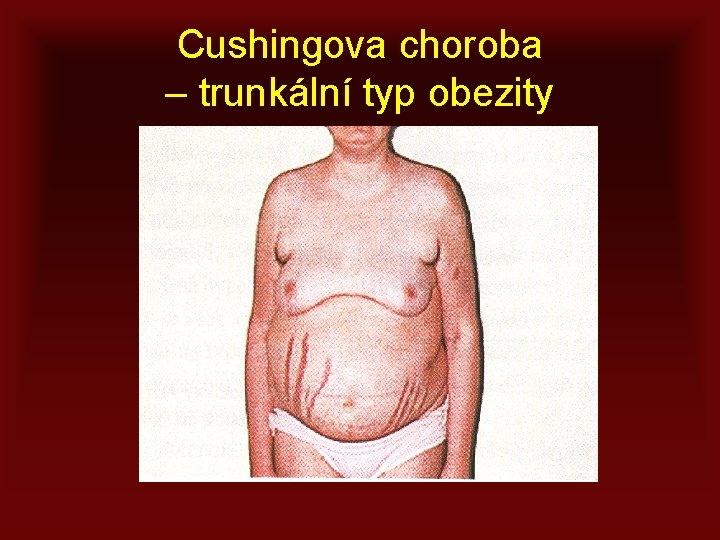 Cushingova choroba – trunkální typ obezity 
