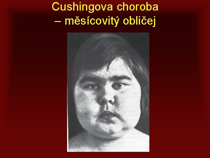 Cushingova choroba – měsícovitý obličej 