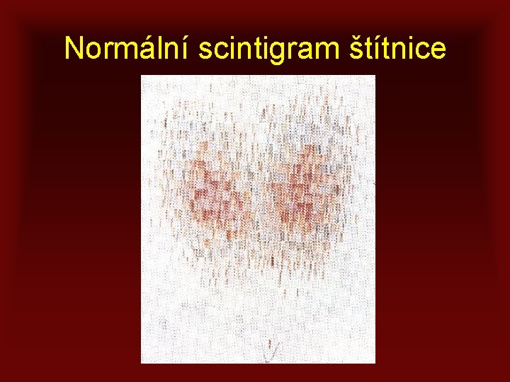 Normální scintigram štítnice 