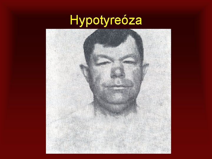 Hypotyreóza 