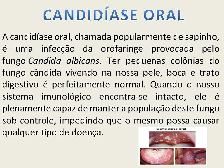 A candidíase oral, chamada popularmente de sapinho, é uma infecção da orofaringe provocada pelo