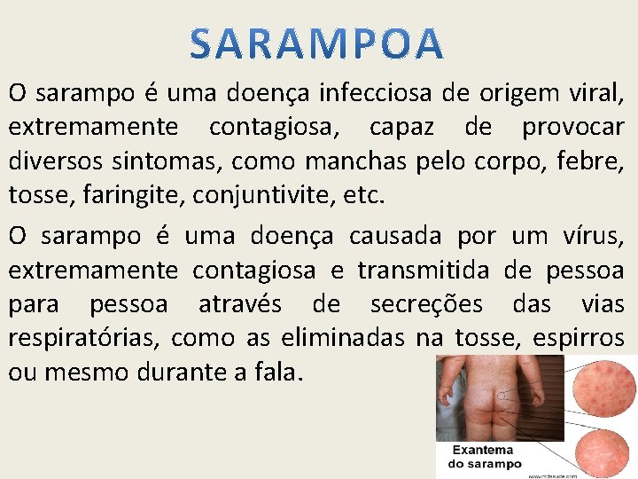 O sarampo é uma doença infecciosa de origem viral, extremamente contagiosa, capaz de provocar