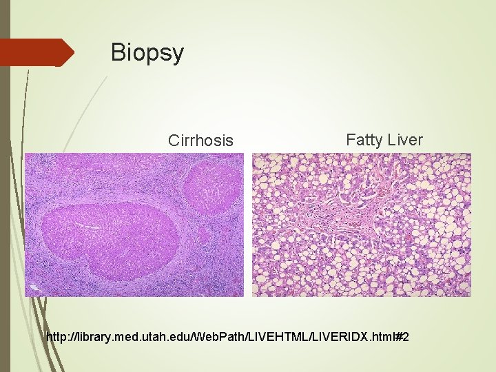 Biopsy Cirrhosis Fatty Liver http: //library. med. utah. edu/Web. Path/LIVEHTML/LIVERIDX. html#2 Biopsy Cirrhosis Fatty Liver http: //library. med. utah. edu/Web. Path/LIVEHTML/LIVERIDX. html#2