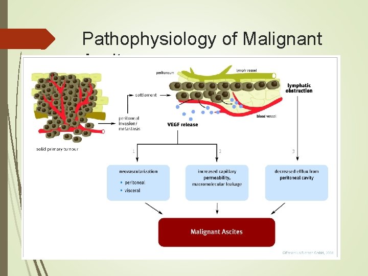 Pathophysiology of Malignant Ascites Pathophysiology of Malignant Ascites