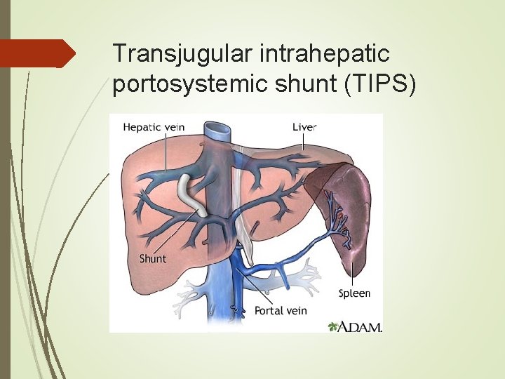 Transjugular intrahepatic portosystemic shunt (TIPS) Transjugular intrahepatic portosystemic shunt (TIPS)
