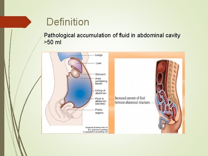 Definition Pathological accumulation of fluid in abdominal cavity >50 ml Definition Pathological accumulation of fluid in abdominal cavity >50 ml