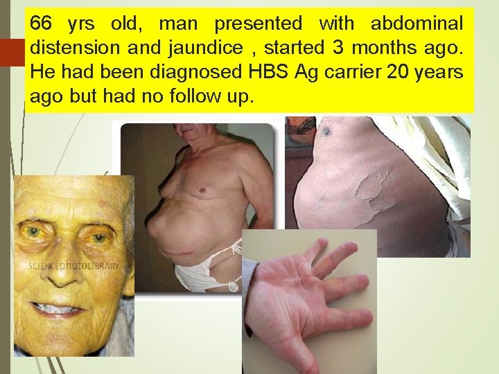 66 yrs old, man presented with abdominal distension and jaundice , started 3 months 66 yrs old, man presented with abdominal distension and jaundice , started 3 months
