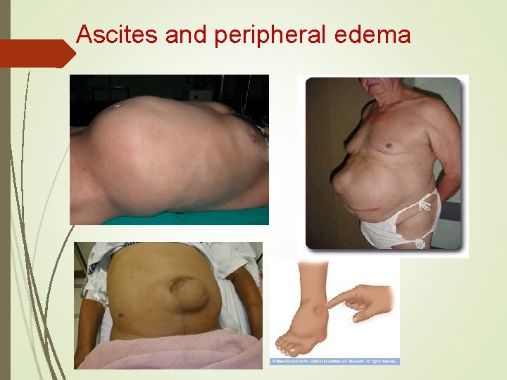 Ascites and peripheral edema Ascites and peripheral edema