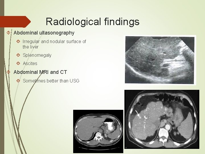 Radiological findings Abdominal ultasonography Irregular and nodular surface of the liver Splenomegaly Ascites Abdominal Radiological findings Abdominal ultasonography Irregular and nodular surface of the liver Splenomegaly Ascites Abdominal