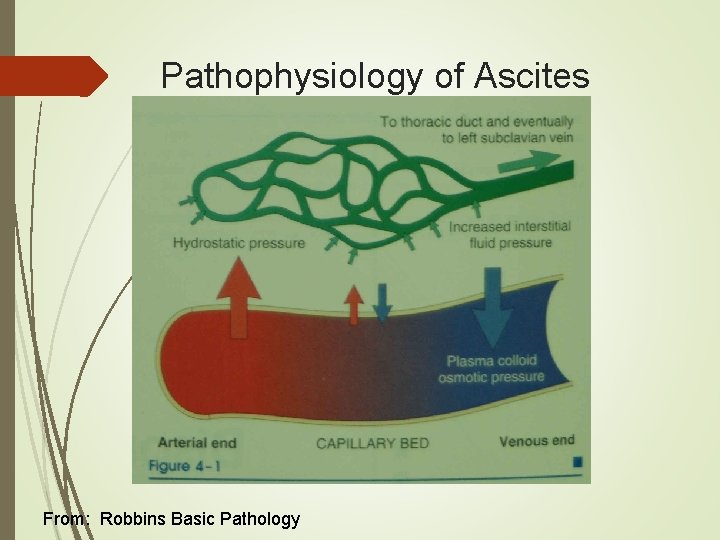 Pathophysiology of Ascites From: Robbins Basic Pathology Pathophysiology of Ascites From: Robbins Basic Pathology