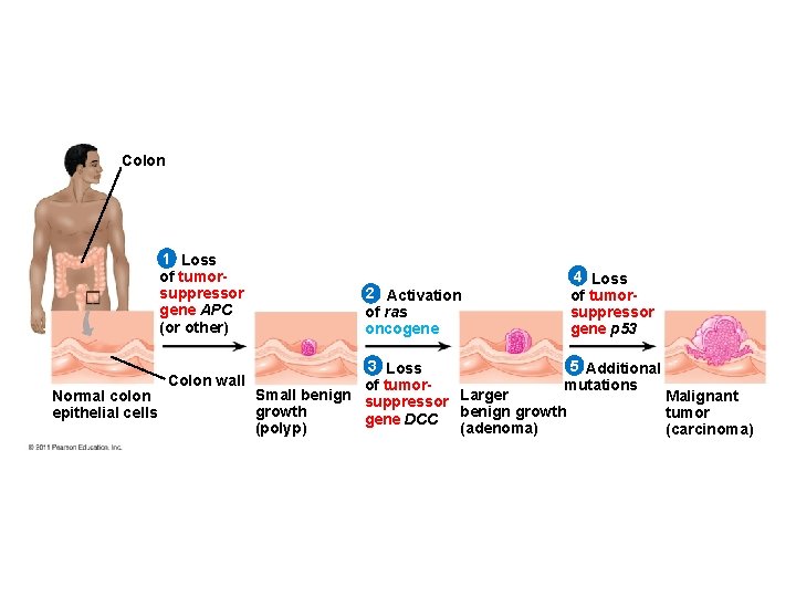 Colon 1 Loss of tumorsuppressor gene APC (or other) Normal colon epithelial cells Colon