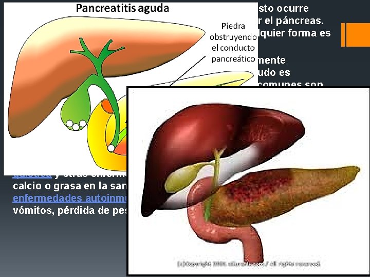 § La pancreatitis es una inflamación del páncreas. Esto ocurre cuando las enzimas digestivas