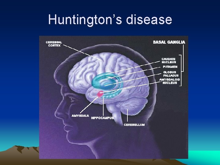 Huntington’s disease 