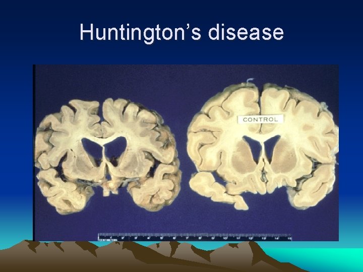Huntington’s disease 